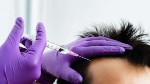 Regenera Activa Saç Tedavisi