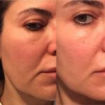 Fast results with Exoscrt Skin Next Generation Exosome Treatment