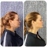Exoscrt Skin Next Generation Exosome Treatment